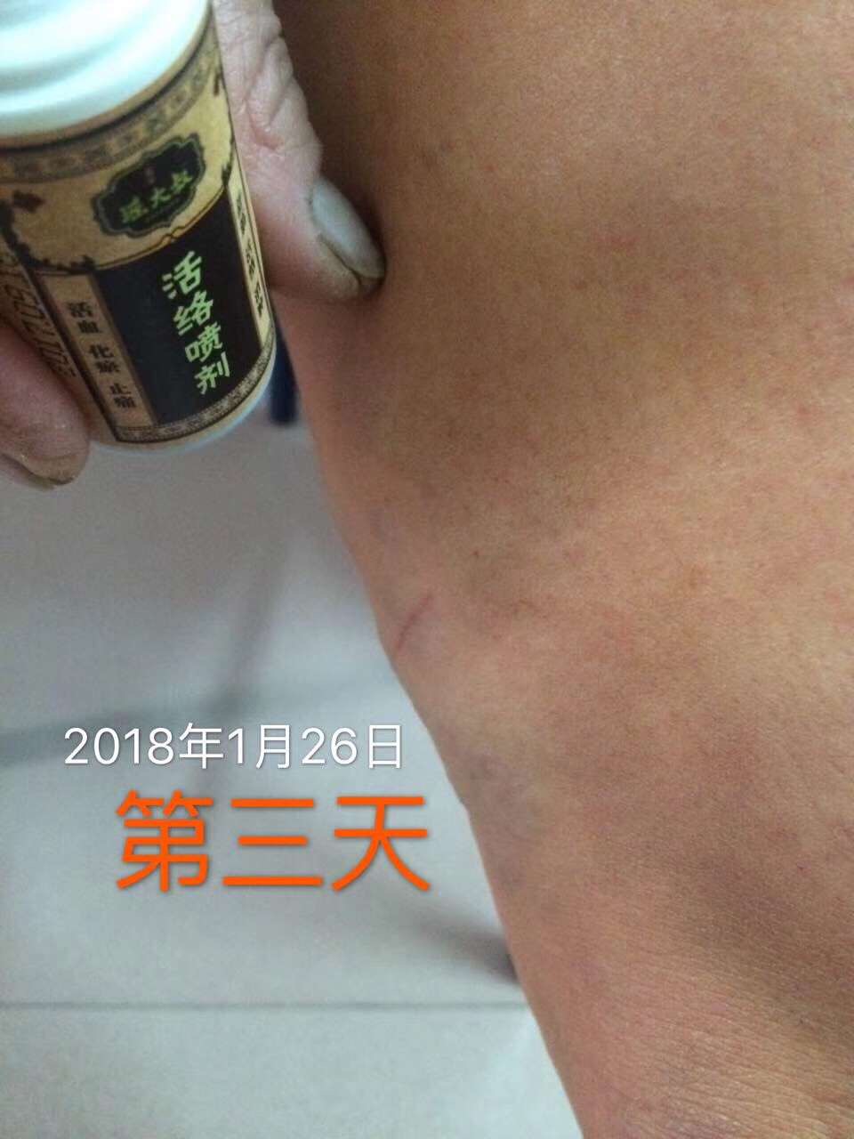 静脉曲张-1-使用2天后-王群英.jpg