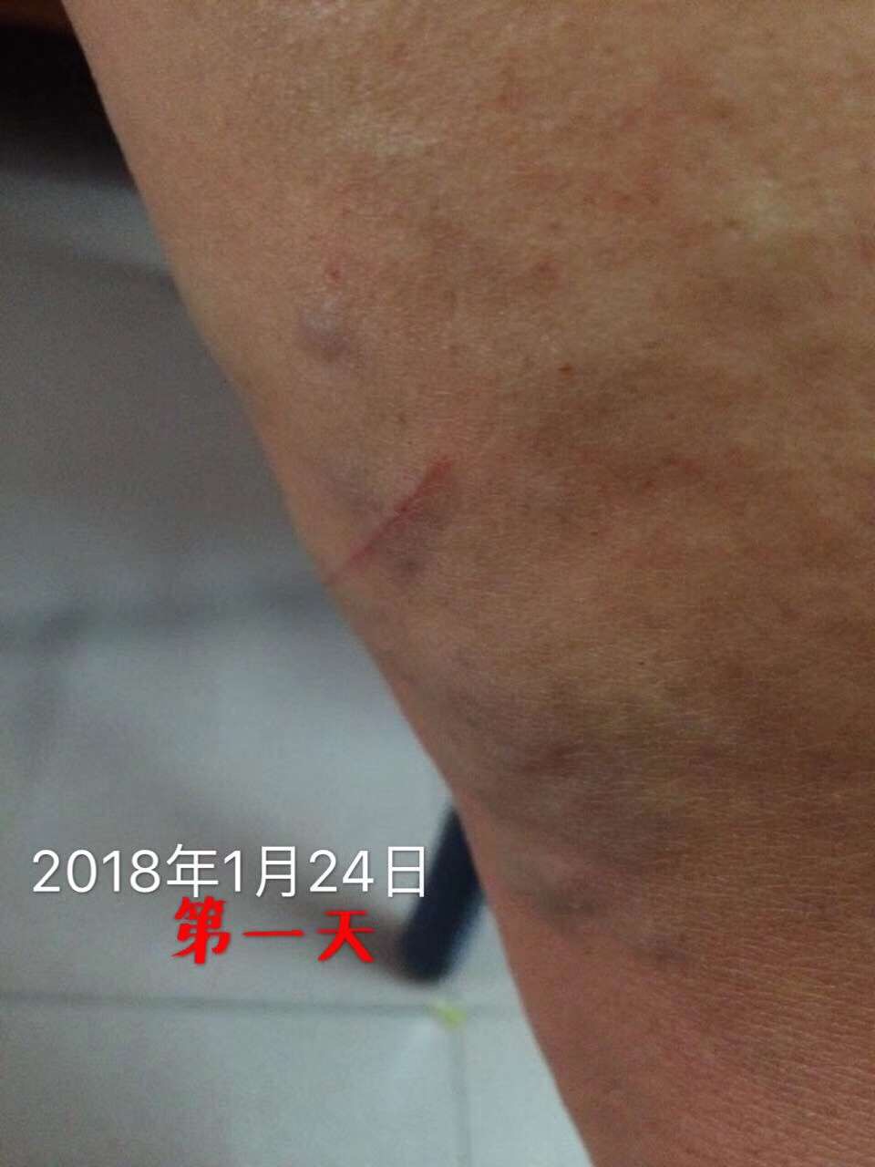 静脉曲张-1-使用前-王群英.jpg